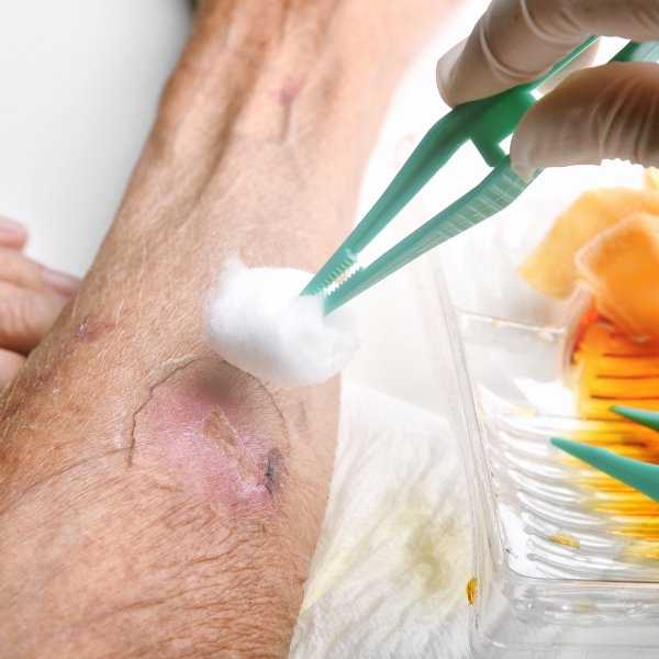 Wound care near me Diabetic foot ulcer treatment in Katy